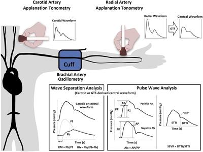 Wave separation analysis-derived indexes obtained from radial and carotid tonometry in healthy pregnancy and pregnancy-associated hypertension: Comparison with pulse wave analysis-derived indexes